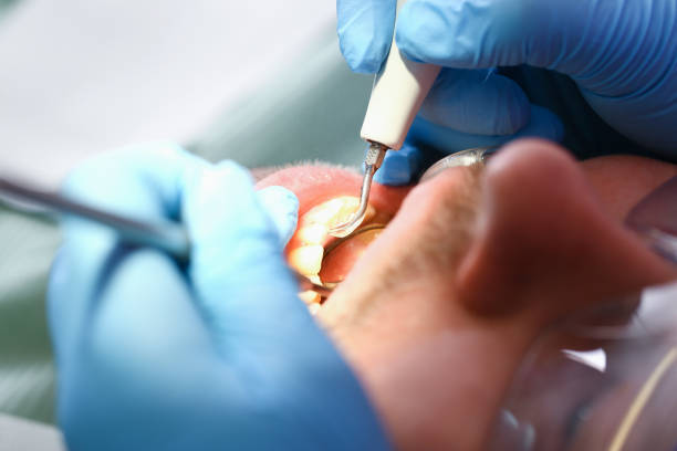 Best Emergency Tooth Extraction in Waynesboro, VA